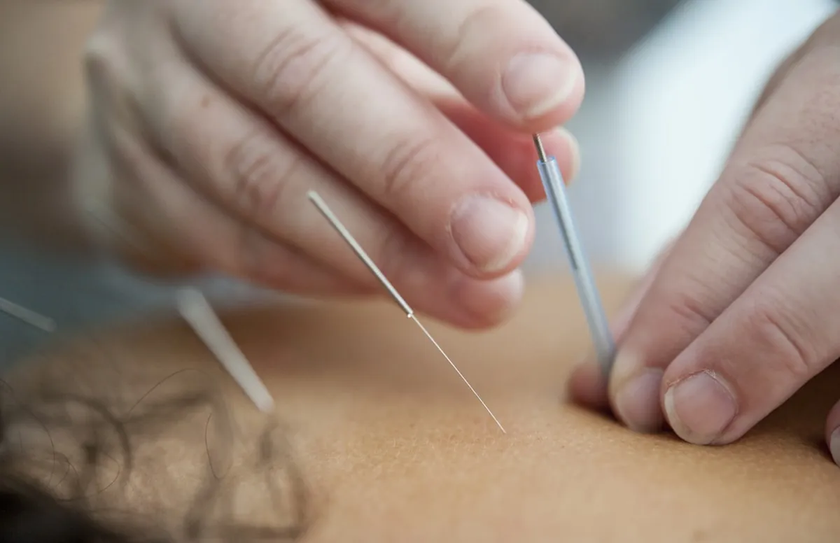 Pose d'aiguilles d'acupuncture stériles