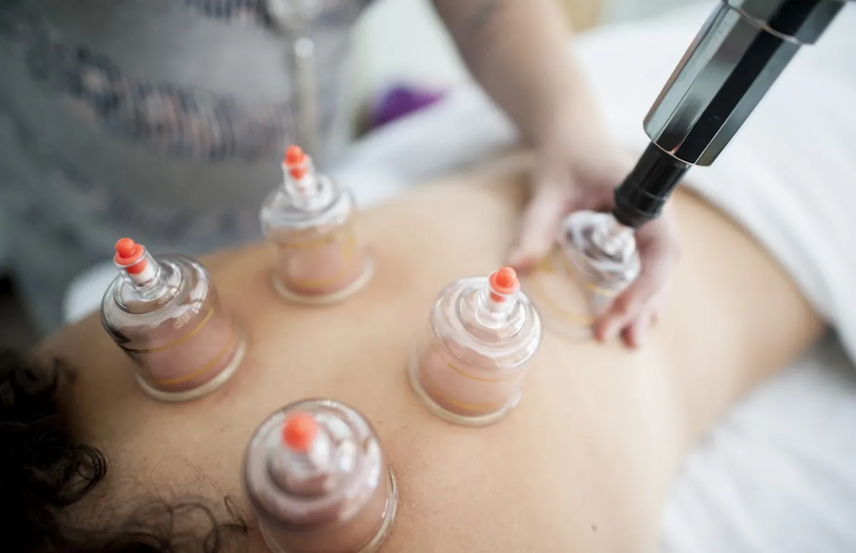Séance de cupping therapy : ventouses posées sur le dos